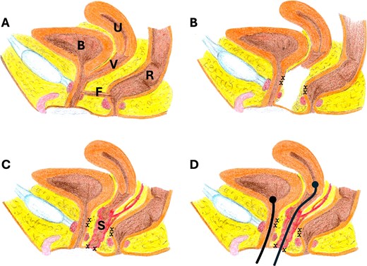 Illustration of the operation steps: (A) the anatomy of the pelvic organs showing the common channel and the fistula (F) location, (B) the fistula was dissected and excised, and the common channel was dissected, (x) indicates the suturing sites, (C) a segment of the sigmoid (with its blood supply and mesentery) was used for sigmoid vaginoplasty, sutured to the skin, (D) urethral catheter and vaginal catheter were placed, the vaginal catheter was applied to overcome the difficulty of suturing the upper vaginal segment with the sigmoid segment (note the absence between the sigmoid segment and the vaginal tube), bladder (B), uterus (U), vagina (V), fistula (F), sigmoid (S).