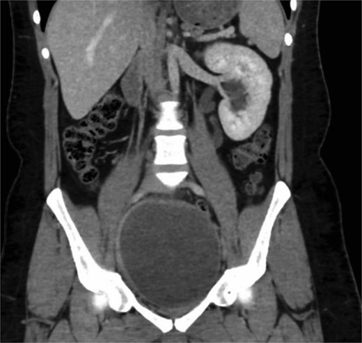 Coronal CT scan showing an enlarged right seminal vesicle cyst measuring 8.2 × 6.4 × 5.1 cm and ipsilateral renal agenesis.