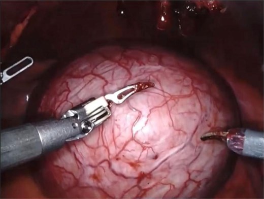 An intraoperative image showing a large right seminal vesicle cyst identified posterior to the bladder.