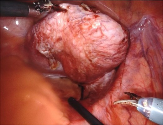 The seminal vesicle cyst after dissection of surrounding tissue and fluid aspiration (150 cc).