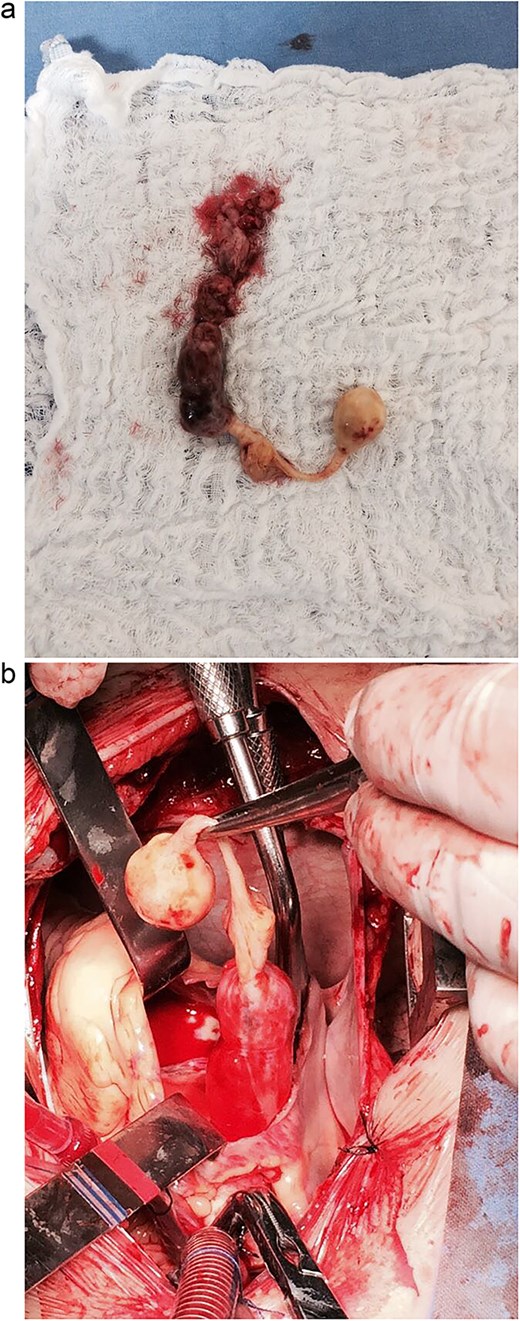 (a) Surgical view of the intracardiac tumor. (b) Intracardiac tumor as a single piece after surgical removal.