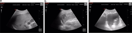 (a) Hepatic ultrasonography demonstrates an intact hepatic capsule with adjacent anechoic fluid collections; (b) splenic imaging reveals discontinuous capsular contour at the diaphragmatic surface with heterogeneous parenchymal echotexture; (c) pelvic cavity shows significant anechoic fluid accumulation.