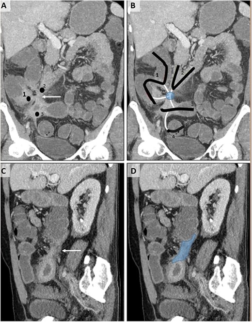 CT enterography examination, coronal (A, B) and sagittal (C, D) MIP (maximum intensity projection) images.Thickening and increased contrast enhancement are observed in the walls of the 2nd–3rd parts of the duodenum (2), terminal ileum (3), and cecum (1) (A). The relationship of these structures, whose lumens are indicated by the same numbers, with the tract-like structures (white lines) of the sigmoid colon (4) — fistulization (circle) — is shown (B). In the sagittal images (C, D), a fistula tract (D, dark area) with a thick wall (C, white arrow) is observed.