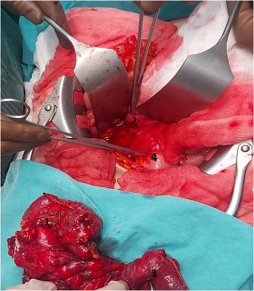 Operation area and surgical material. 2nd–3rd parts of the duodenum (2), sigmoid colon (4), terminal ileum (3), and cecum (1).