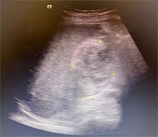 Ultrasound abdomen showing oedematous gallbladder with a heterogenous hypoechoic collection in gallbladder fossa (approximately measuring 9 × 4 cm).
