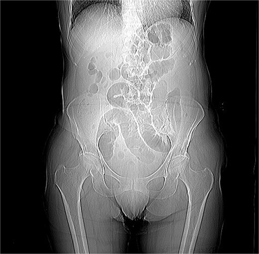 Coronal abdominal RX.