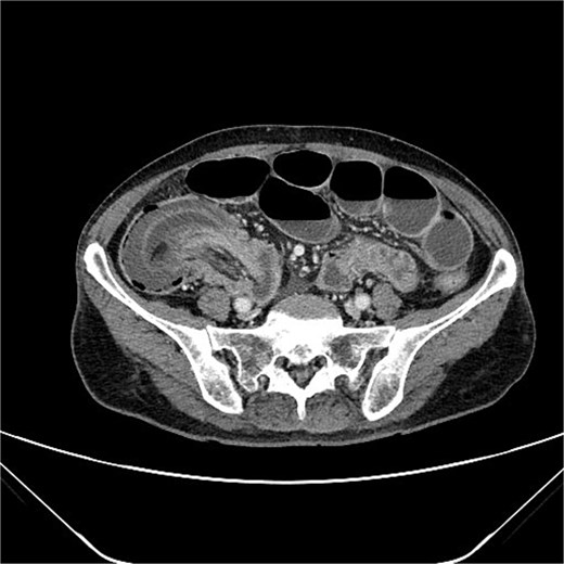 Axial abdominal CT scan.