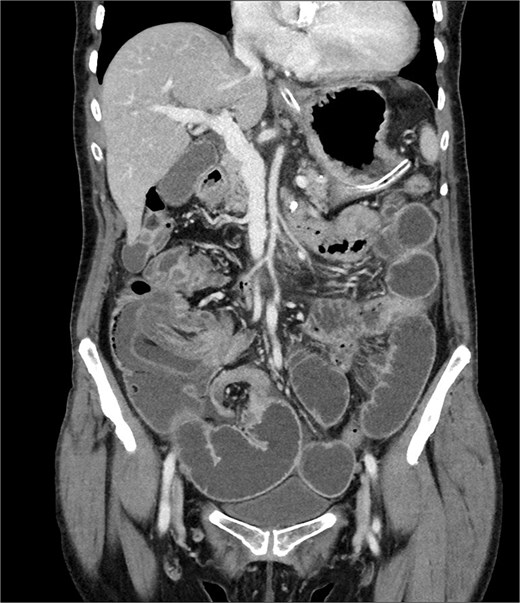 Coronal abdominal CT scan.
