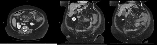 Abdominal E-CT of the first patient at admission. The white arrows indicate extended porto-mesenteric thrombosis, while the dashed arrows reveal jejunal venous ischemia with a lack of bowel wall enhancement, bowel distension, and free fluid.