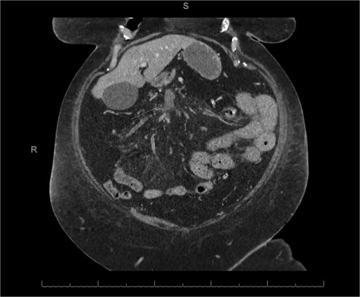 Follow-up E-CT 72 h after conservative management in the first patient. Dashed arrows show improved viability of the small bowel with bowel wall enhancement. White arrows revealed the stability of the extended porto-mesenteric thrombosis.