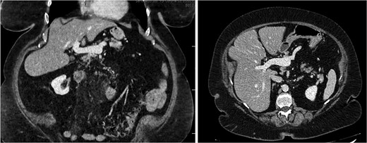 Three-month E-CT of the first patient showing nearly complete thrombosis resolution, with no signs of intestinal distress.