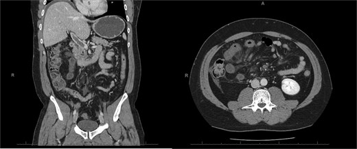 E-CT in the second patient at admission. White arrows showing porto-mesenteric thrombosis. Dashed arrows indicate a portion of small bowel loop ischemia in the right lower quadrant characterized by the absence of bowel wall enhancement and free fluid.