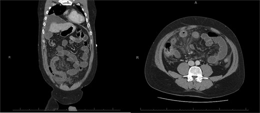 E-CT of the second patient 48 h after conservative management, showing no further complications, including no signs of perforation regarding the bowel wall located with dashed arrows.