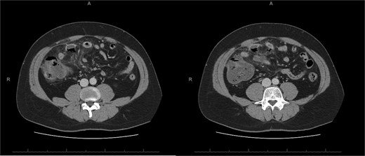 E-CT of the second patient, 20 days after the first admission. White arrows show covered perforation concerning the previous ischemic small bowel loop.