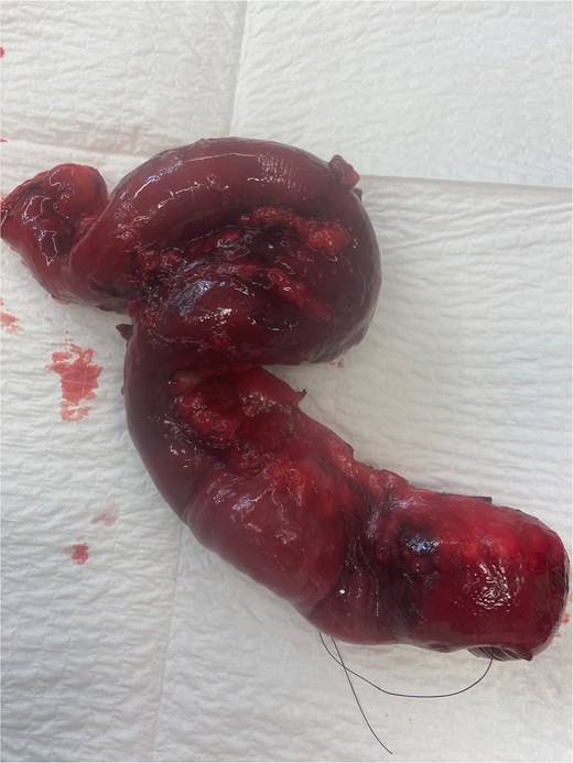Perioperative images of the resected ischemic perforated jejunal segment in our second patient.