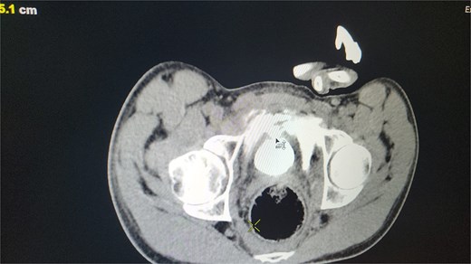 CT scan reveals contrast material leaking from the bladder lumen into the surrounding pelvic cavity, indicating a bladder rupture.