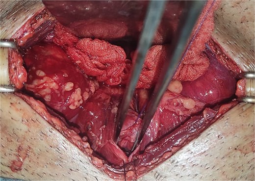 The image shows an extraperitoneal bladder rupture, revealing a tear in the bladder wall and damage to surrounding tissues.