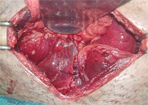 The image depicts the bladder after surgical repair, showing the successfully sutured rupture site and restored continuity.