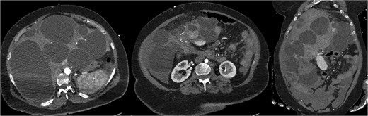 CTMA with axial and coronal views demonstrates a massively dysmorphic polycystic liver with haemoperitoneum and heterogeneously hyperdense material near inferior aspect of liver.