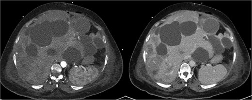 Repeat CTMA with arterial enhancement within the left hepatic lobe (arrow, left image), appearing more ill-defined with contrast pooling on delayed phase (arrow, right image) suggestive of active haemorrhage.