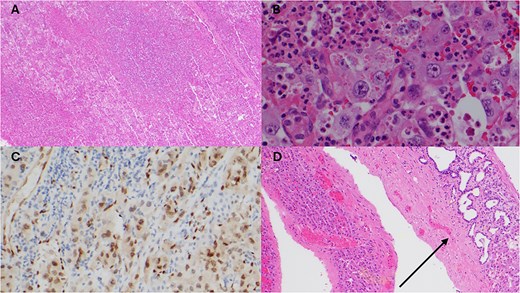 Histopathology of resected liver specimen. (A) Epithelioid angiosarcoma involving liver parenchyma with broad areas of necrosis (4× magnification). (B) Round to polygonal epithelioid tumour cells with prominent nucleoli, and associated red blood cells and neutrophils (40× magnification). (C) ERG immunohistochemistry staining tumour nuclei (20× magnification). (D) Polycystic liver disease, numerous cysts, some with von Meyenburg complexes (arrow) (10× magnification).