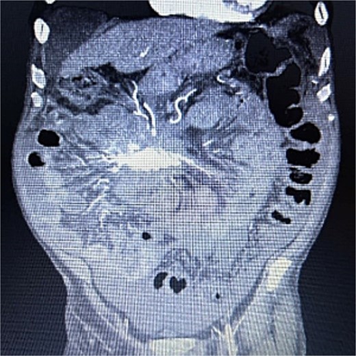 Anterior–posterior view of CT abdomen/pelvis scan showing large, central calcified mesenteric mass, Case 1.