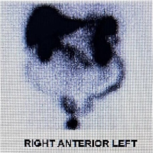 Gallium DOTATATE scan showing increased uptake at the location of the mesenteric mass, Case 1.