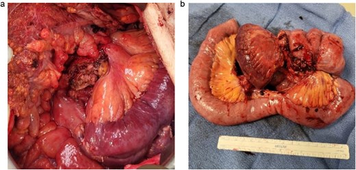 Small bowel and mesenteric mass resection specimens, Case 1.