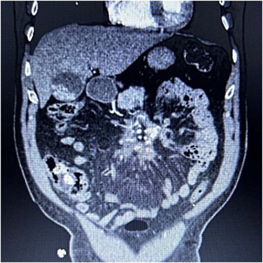CTA abdomen/pelvis showing central calcified mesenteric mass, Case 2.