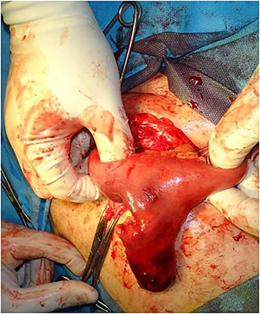 Intraoperative photograph after opening the hernial sac, showing the incarcerated Meckel's diverticulum.
