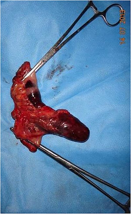 Surgically resected Meckel's diverticulum shown.
