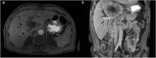 (a) Axial contrast enhanced CT scan shows a central infiltrative lesion in the hepatic parenchyma, affecting segments I, IV, and VIII, measuring 11.0 × 8.8 cm. (b) Coronal contrast enhanced CT scan the mass causing obstruction of the bile duct at the confluence of the hepatic ducts and involvement of segmental ducts of both lobes.