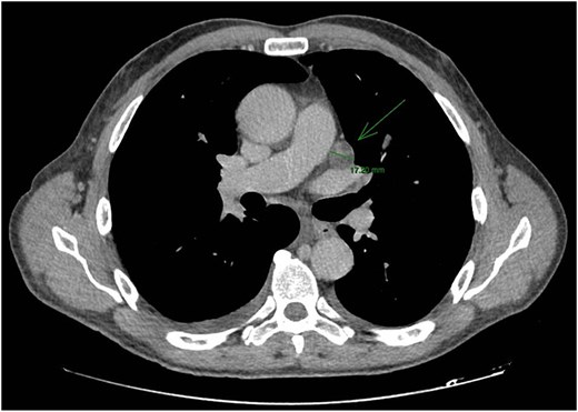 CT staging of the chest and pelvis showed the presence of subaortic, peri-esophageal, and hilar necrotic lymph node enlargement on the left, suggestive of secondary implants.