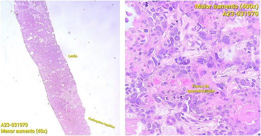 Photomicrographs of orophyarngeal biopsy showing squamous cell carcinoma: Islands of tumor cells along with chronic inflammatory infiltrate (hematoxylin and eosin staining).