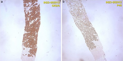 (a) Immunohistochemically, the tumor cells were cytokeratin 5/6(+). (b) Immunohistochemically, the tumor cells were p40 (+).