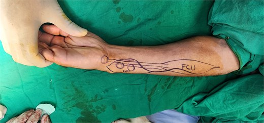 Photograph of preoperative markings and perforator identification.