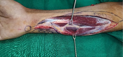 Photograph showing absent ulnar artery, intact ulnar nerve, and perforators running from median artery to the skin.