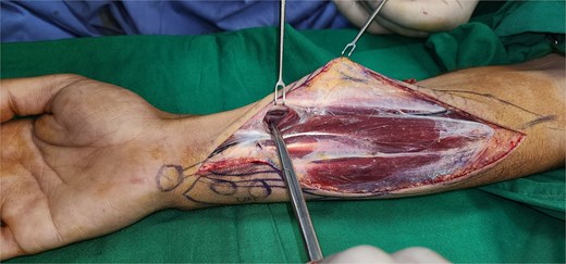 Photographs showing radial artery.