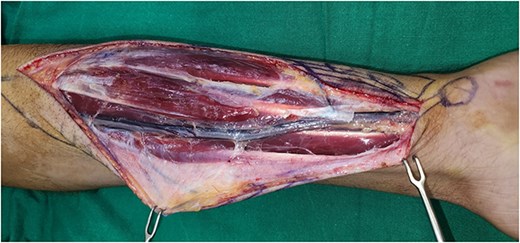 Photograph showing dissected median artery and divided palmaris longus tendon.