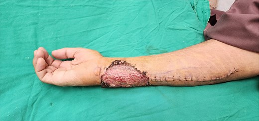 Photographs showing donor site closure with skin graft.