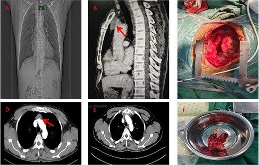 (A) Preoperative chest X-ray (coronal view). (B) Preoperative CT scan (sagittal view) showing the anterior mediastinal mass (arrow). (C) Intraoperative view of the resected specimen. (D) Preoperative CT scan (axial view) showing the anterior mediastinal mass (arrow). (E) Post-operative imaging at 3 months following surgery and radiotherapy (RT). (F) Photograph of the surgical specimen.
