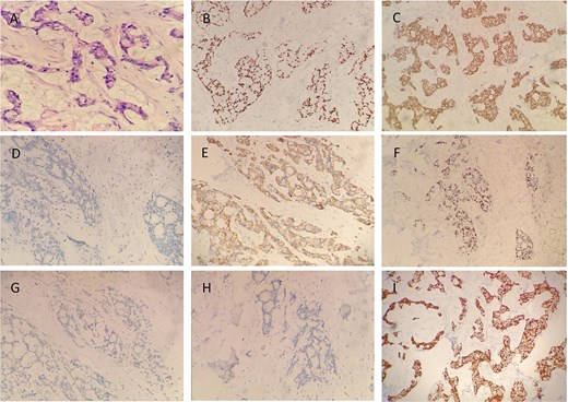 Immunohistochemical staining results revealed the following expression profile in the tumor cells: CK (+), CK20 (−), CK7 (−), CDX2 (+), villin (+), TTF-1 (−), P63 (−), S100 (−), CD5 (−), and Ki-67 ~50% (magnification ×100). Representative images of immunohistochemical staining are shown in figure (A) H&E, (B) CDX2, (C) CK, (D) CK7, (E) CK20, (F) Ki-67, (G) P63, (H) S100, and (I) villin (magnification ×100).