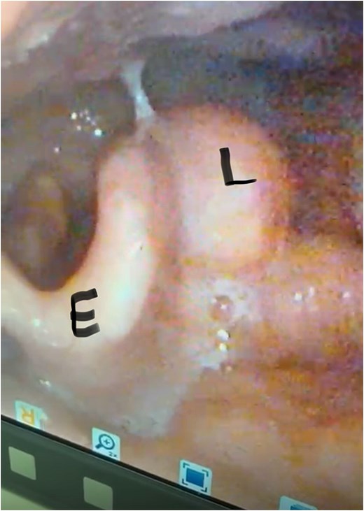 Pre-operative nasal endoscopy showing a rounded, submucosal mass (L) in the left aryepiglottic fold. The epiglottis (E) appears normal with no signs of inflammation or distortion. Note the smooth contour of the lesion with intact overlying mucosa.