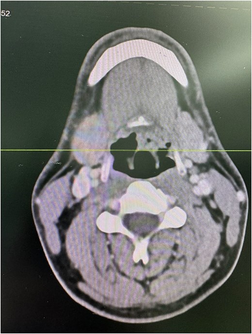 Axial CT scan of the neck with intravenous contrast demonstrating a 4 × 4 mm non-enhancing nodule (arrow) in the posterior aspect of the upper end of the left aryepiglottic fold. Asymmetry of the vallecula is noted with shallowness on the left side, likely due to the extension of the lingual tonsils.