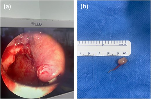 (a) Microlaryngoscopy view following excision of the left aryepiglottic fold mass. The surgical site shows clean margins with no residual lesion, and the surrounding mucosa appears intact. (b) Gross specimen of the excised lesion: a 1 × 1 cm cystic mass with smooth, pale-yellow surface and intact overlying mucosa.