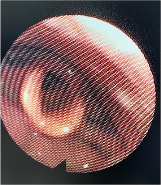 Six-month post-operative nasal endoscopy. The left aryepiglottic fold demonstrates well-healed mucosa with no residual mass, scarring, or asymmetry. The laryngeal structures appear normal with no evidence of recurrence.