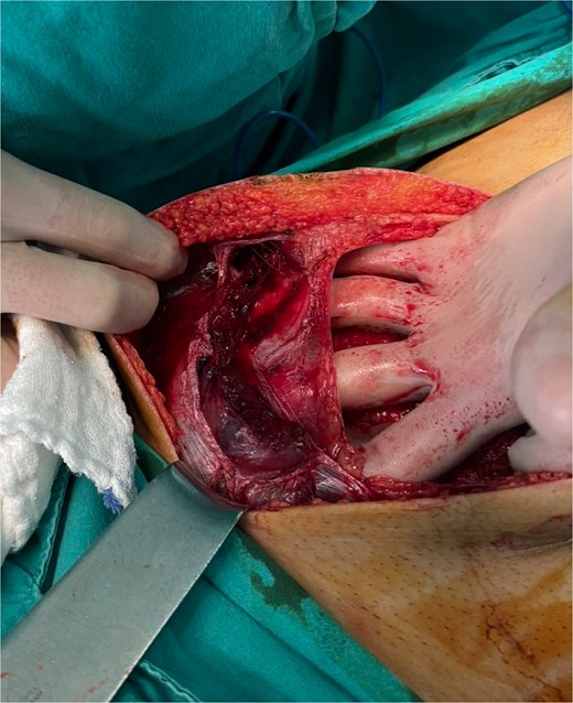 Rectus muscles transection.