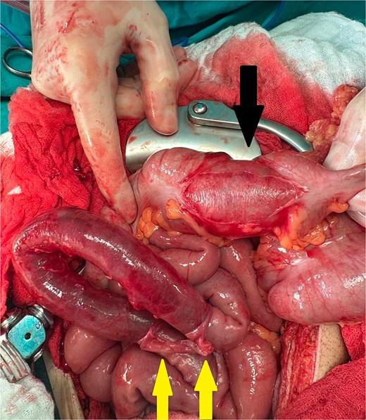 Ascending colon laceration <50% (black arrow) and degloving injury to the small intestine (yellow arrows).