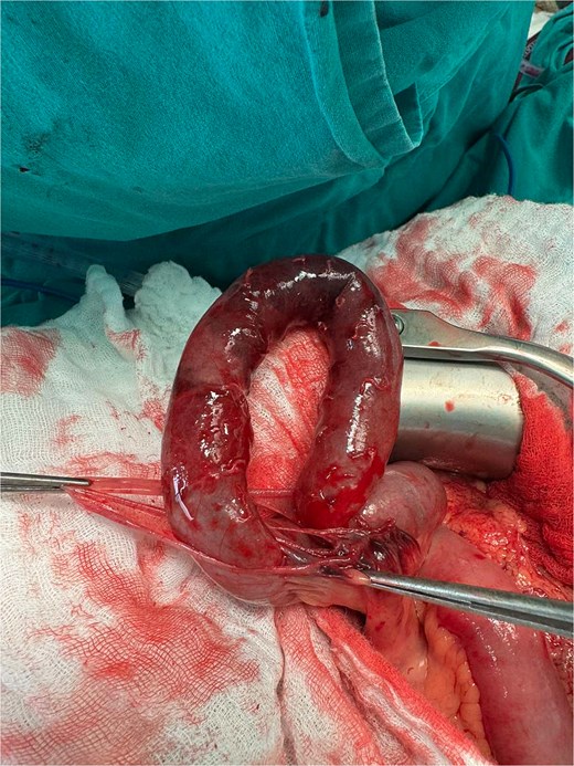 Small intestine from Fig. 3 (instruments holding the torn intestinal serosa).