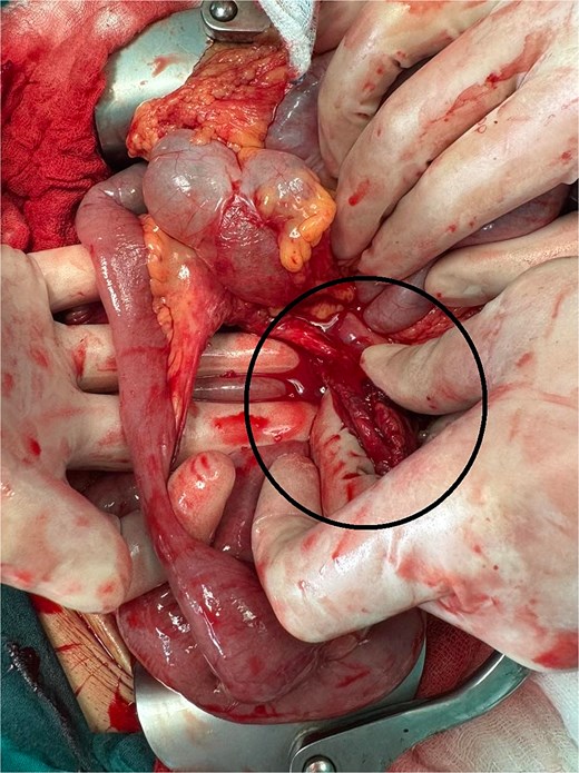 Devascularized intestine with mesentery defect and bleeding point (encircled) manually compressed by the 1st assistant.